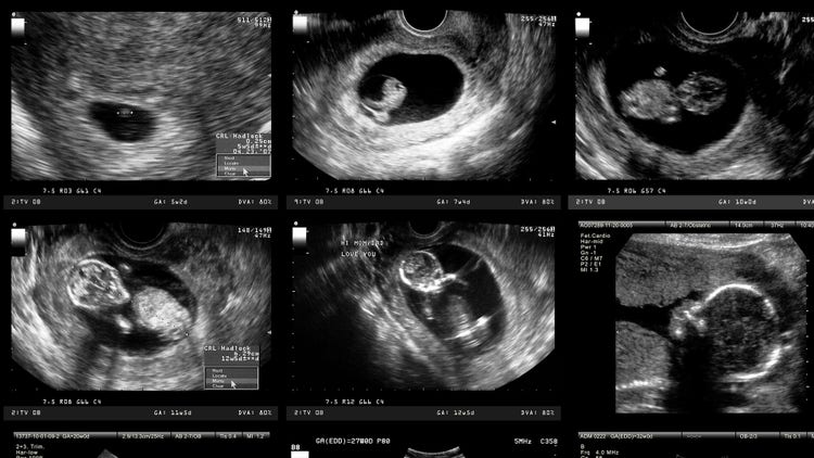 Flint Water Crisis - Fetal Death Rates